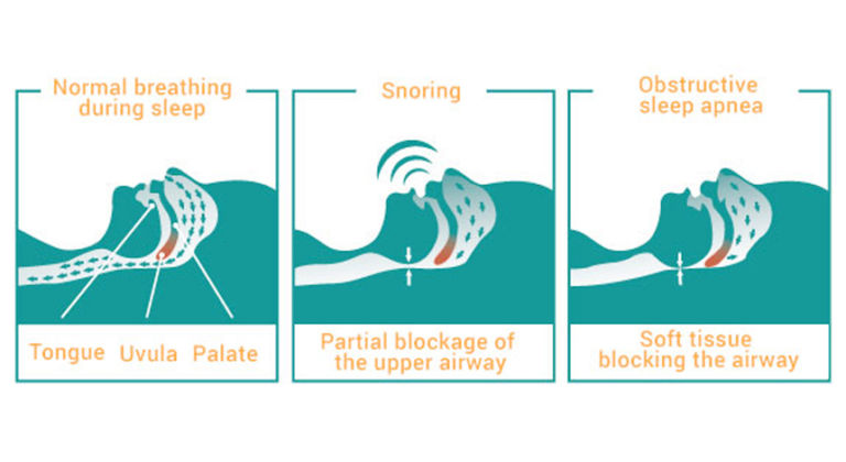 Obstructive Sleep Apnea - Aashwi E.N.T Hospital