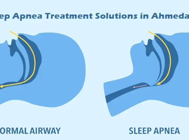 Sleep Apnea Treatment Solutions in Ahmedabad