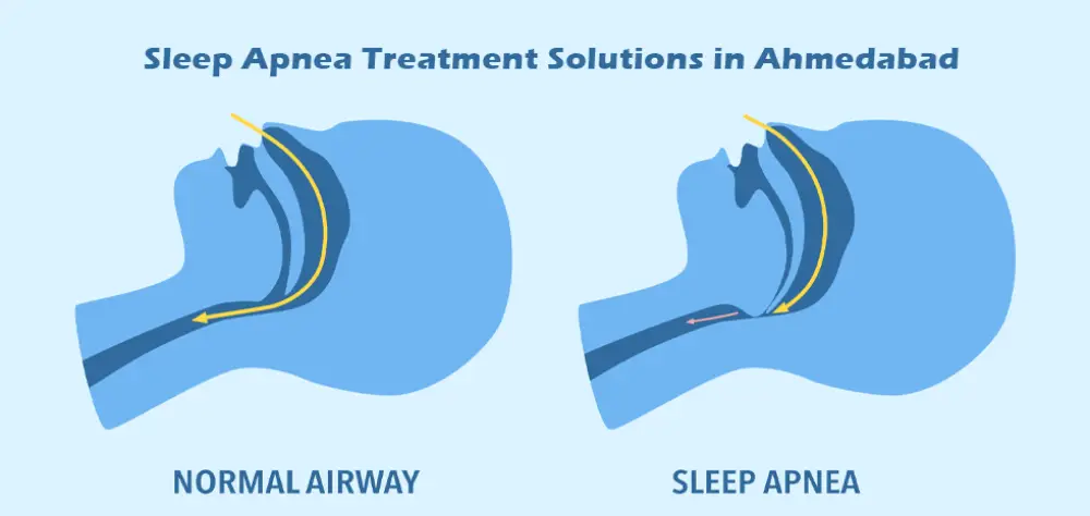 Sleep Apnea Treatment Solutions in Ahmedabad