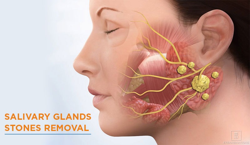 Salivary Glands Stones Removal