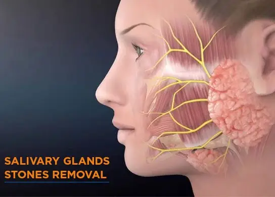 Salivary Glands Stones Removal
